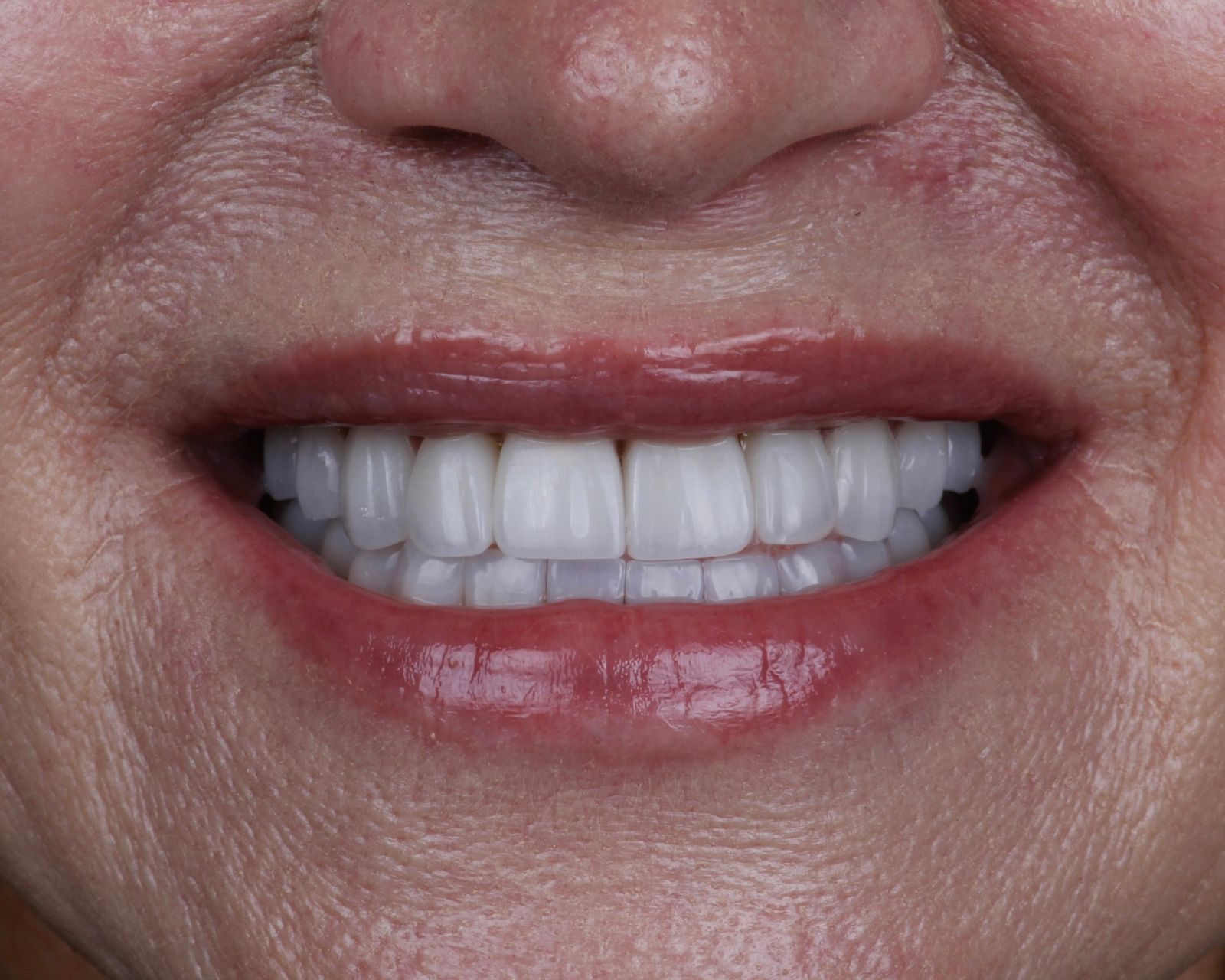 Resultado de Implantes dentales
